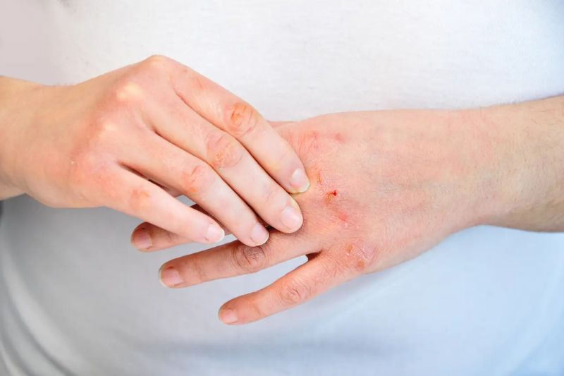 Verschil tussen latexallergie, contactallergie en huidirritatie bij gebruik van handschoenen | ABENA