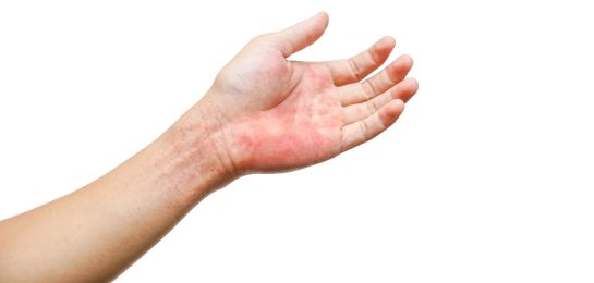 Verschil tussen latexallergie, contactallergie en huidirritatie bij gebruik van handschoenen | ABENA